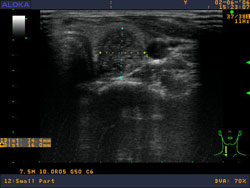 Ультразвуковая картина при узле щитовидной железы